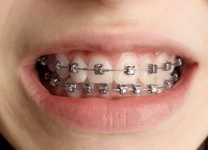 Orthodontic Consult Package