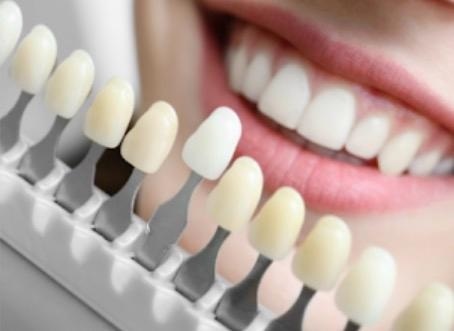 Professional Teeth Whitening